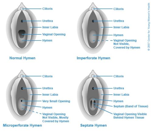 Types of hymens